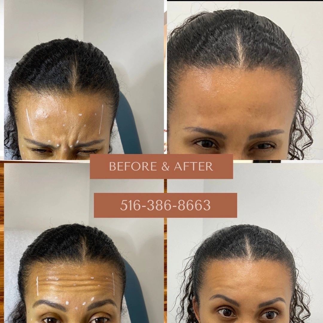 Forehead lines: before and after